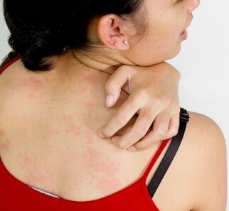 Granulome am Körper - Symptome für das Vorhandensein von Parasiten