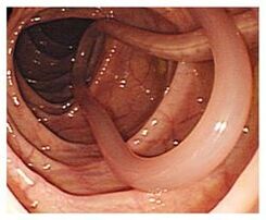 Parasiten im menschlichen Körper