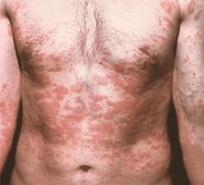 Problematische Haut ist ein Symptom für das Vorhandensein von Parasiten