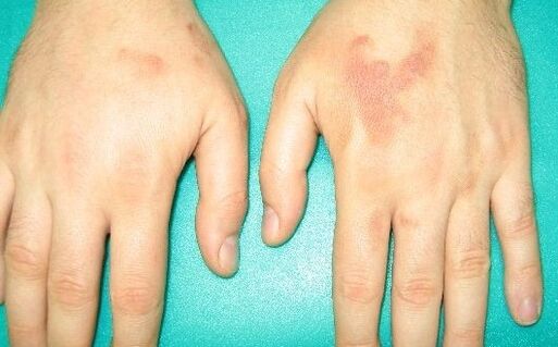 Schmerzen in den Gelenken der Hände können Symptome von Parasiten sein