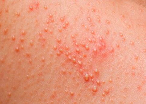 Wenn der Körper von Parasiten befallen ist, tritt eine Hautallergie auf