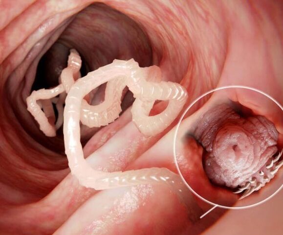 Würmer im menschlichen Darm Foto 2