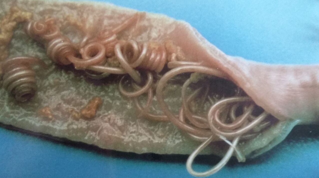 Spulwurmwürmer aus dem menschlichen Körper