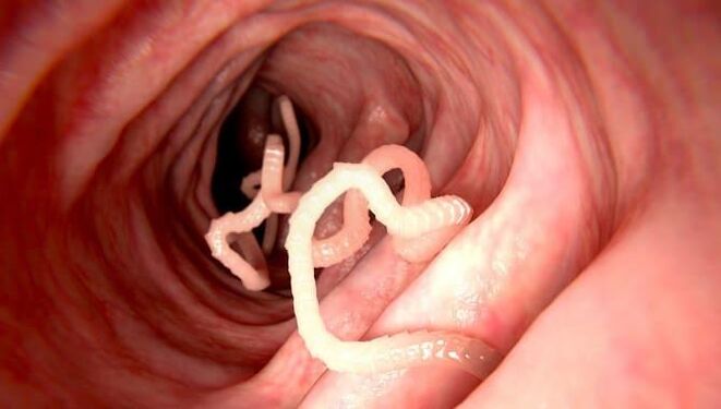 Würmer, die im menschlichen Darm leben