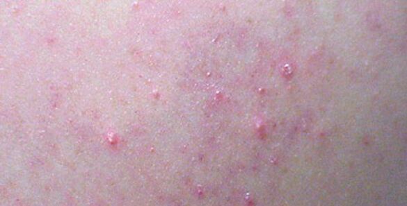 Hautausschläge können ein Zeichen einer Helminthiasis sein